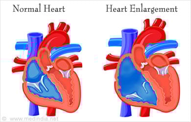 Complications of Chorioangioma � Heart Enlargement Complications of Chorioangioma � Heart Enlargement