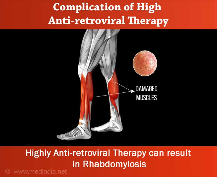 Complication of Highly Active Antiretroviral Therapy - Rhabdomyolysis Complication of Highly Active Antiretroviral Therapy - Rhabdomyolysis