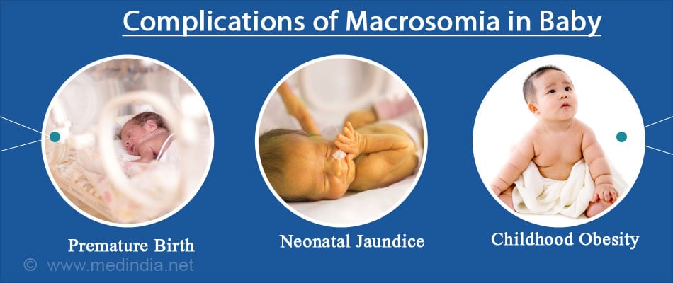 What Causes Big Babies? Busting Myths About Macrosomic Babies