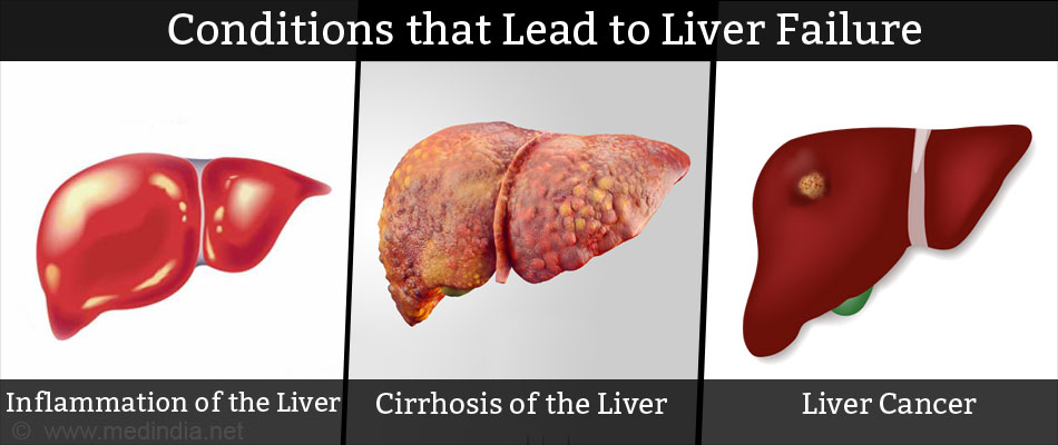 Liver Transplantation - Facts, Contraindications, Procedure, Follow Up 