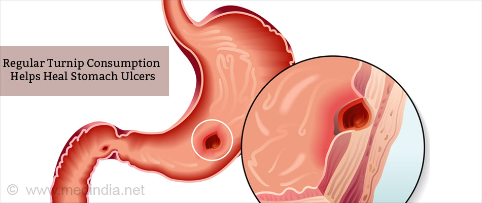 Regular Turnip Consumption Helps Heal Stomach Ulcers Regular Turnip Consumption Helps Heal Stomach Ulcers