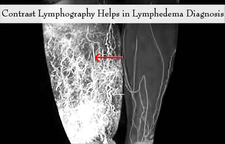 Contrast Lymphography Contrast Lymphography