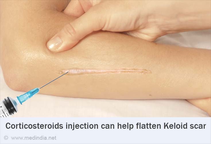 Keloids Causes Symptoms Diagnosis Treatment Prevention