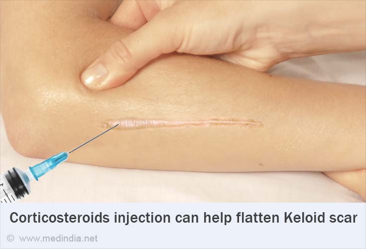 Keloids Causes, Symptoms, Diagnosis, Treatment & Prevention