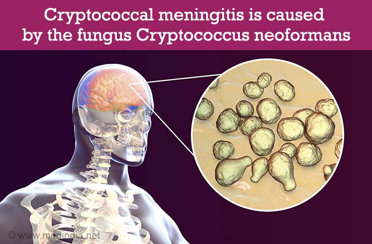 Cryptococcal Meningitis Causes Risk Factors Symptoms Diagnosis