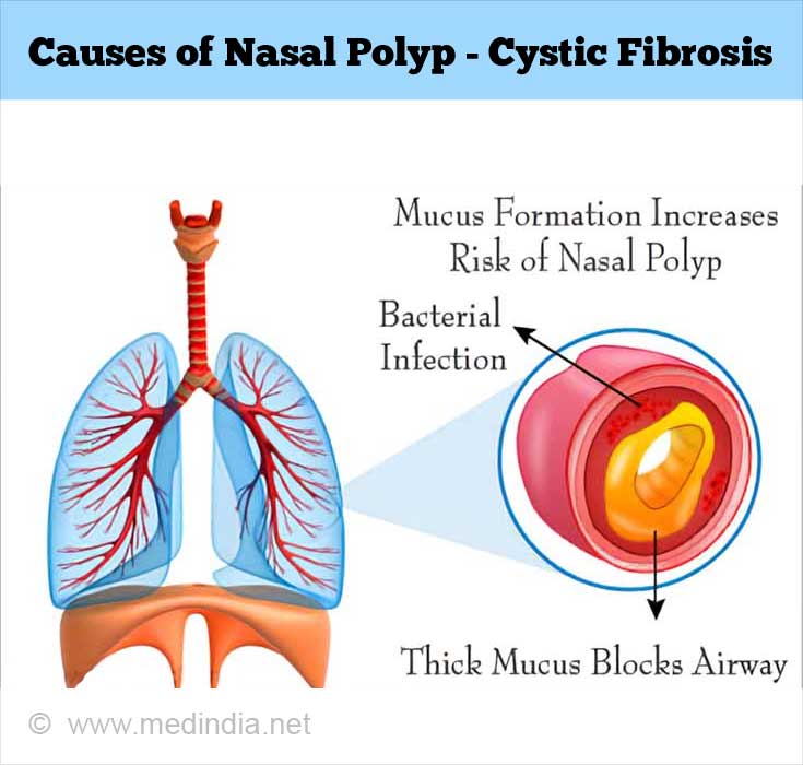 Nasal Polyp Causes Symptoms Treatment Nasal Polyp