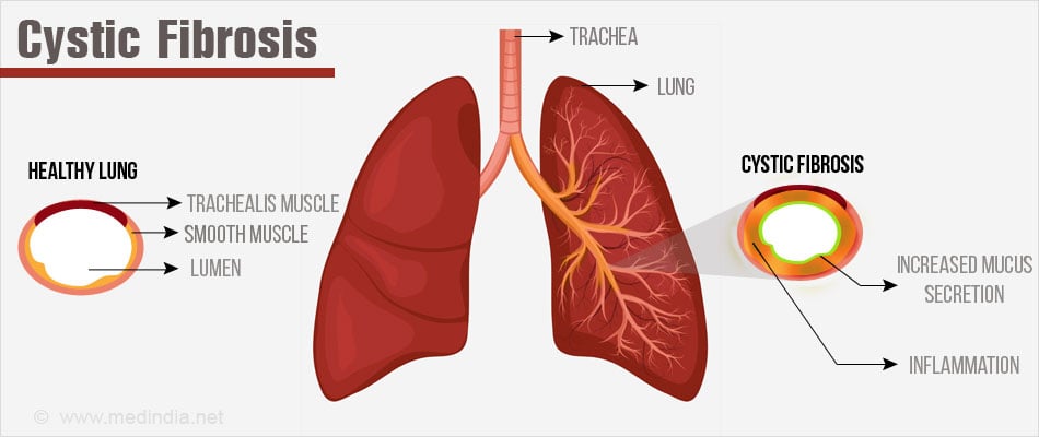 cystic fibrosis lungs diagram