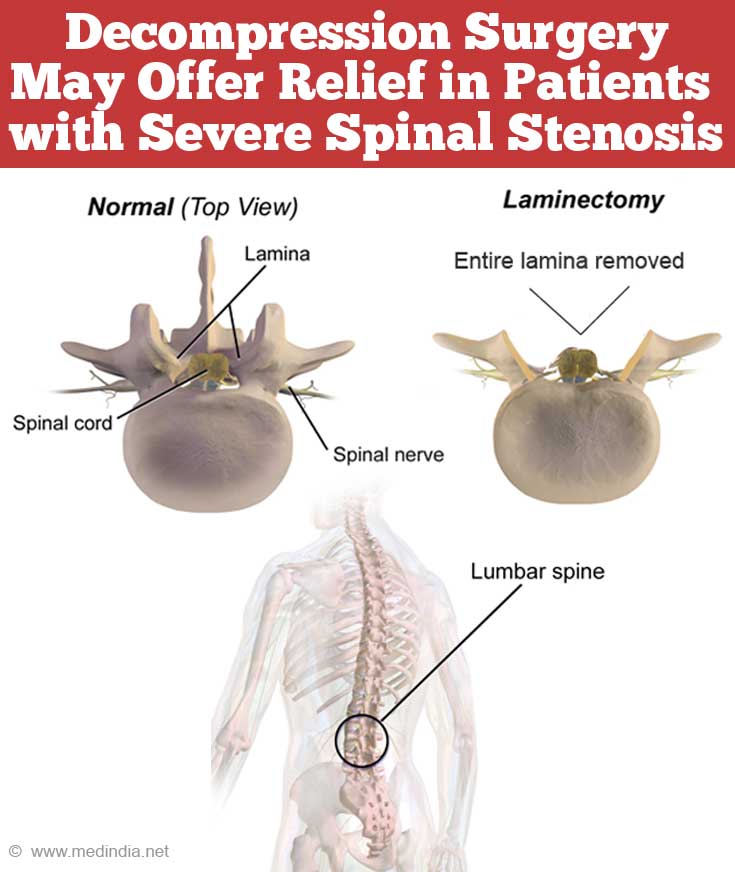 https://images.medindia.net/patientinfo/950_400/decompression-surgery-may-offer-relief-in-patients-with-severe-spinal-stenosis.jpg