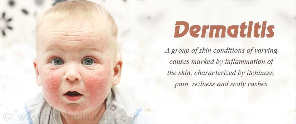 Dermatitis Dermatitis