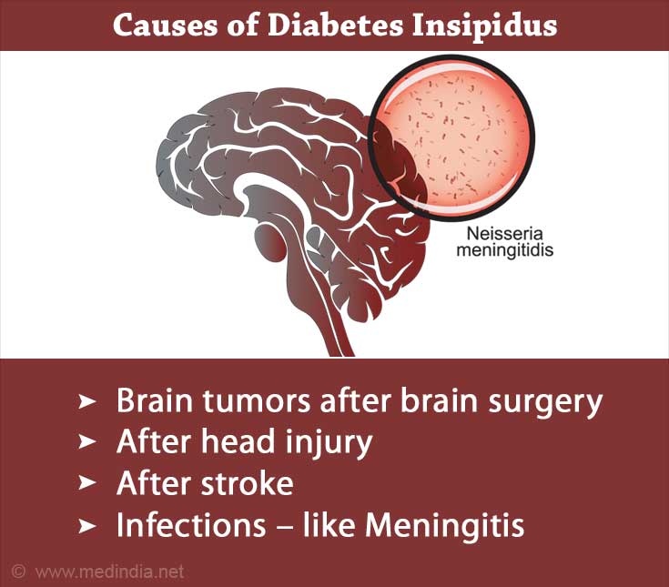 Diabetes Insipidus Causes Symptoms Diagnosis Treatment Complications 0956