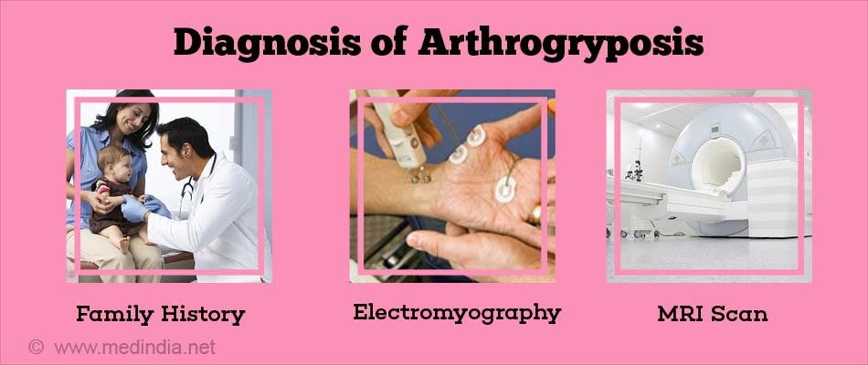 Arthrogryposis - Types, Causes, Clinical features, Diagnosis and Treatment