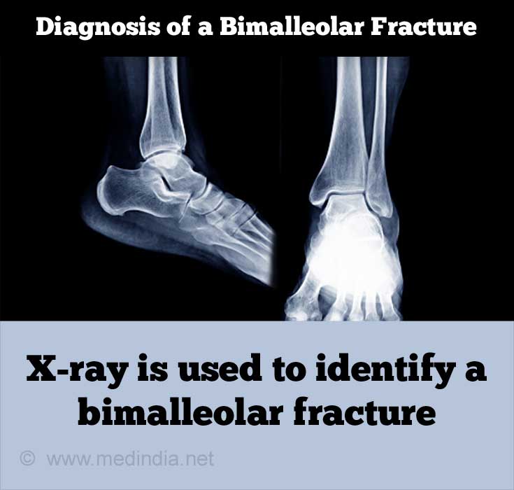 Bimalleolar Fracture - Diagnosis Bimalleolar Fracture - Diagnosis