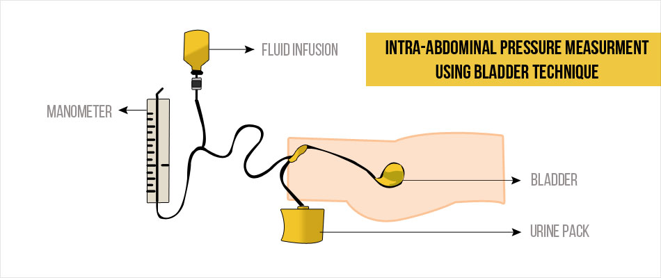 Diagnosis of Abdominal Compartment Syndrome Urinary Catheter Diagnosis of Abdominal Compartment Syndrome Urinary Catheter