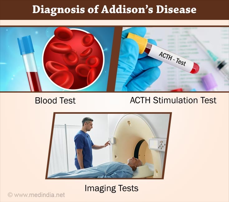 Diagnosis of Addison's Disease