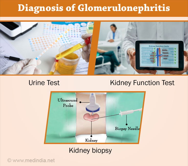 Diagnosis of Glomerulonephritis