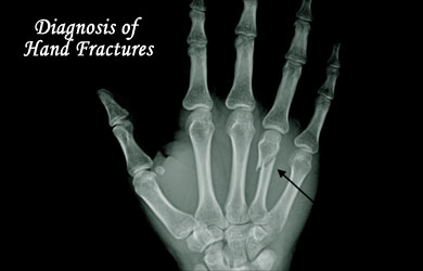 Diagnosis of Hand Fractures Diagnosis of Hand Fractures