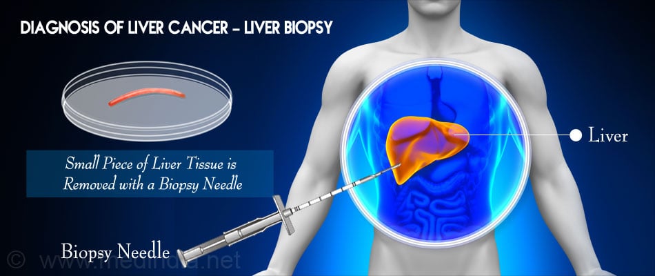 Quimioterapia en pastillas para cáncer de hígado