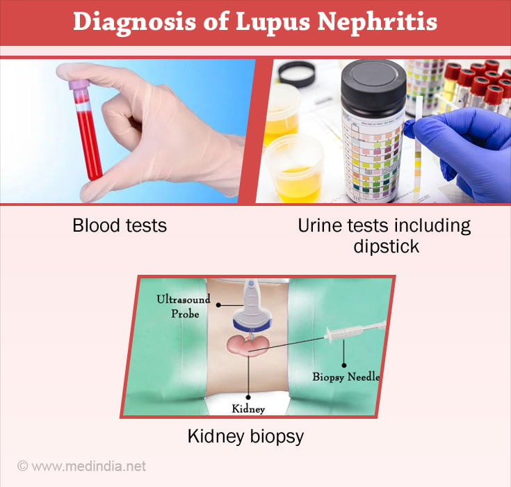 Diagnosis of Lupus Nephritis