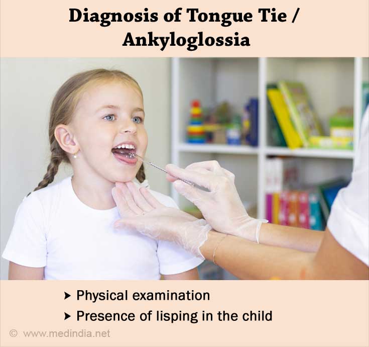 Tongue Tie Ankyloglossia 6548