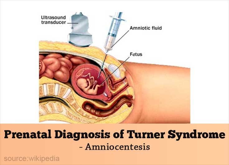 what causes turner syndrome