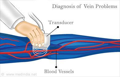 Diagnosis of Vein Problems Diagnosis of Vein Problems
