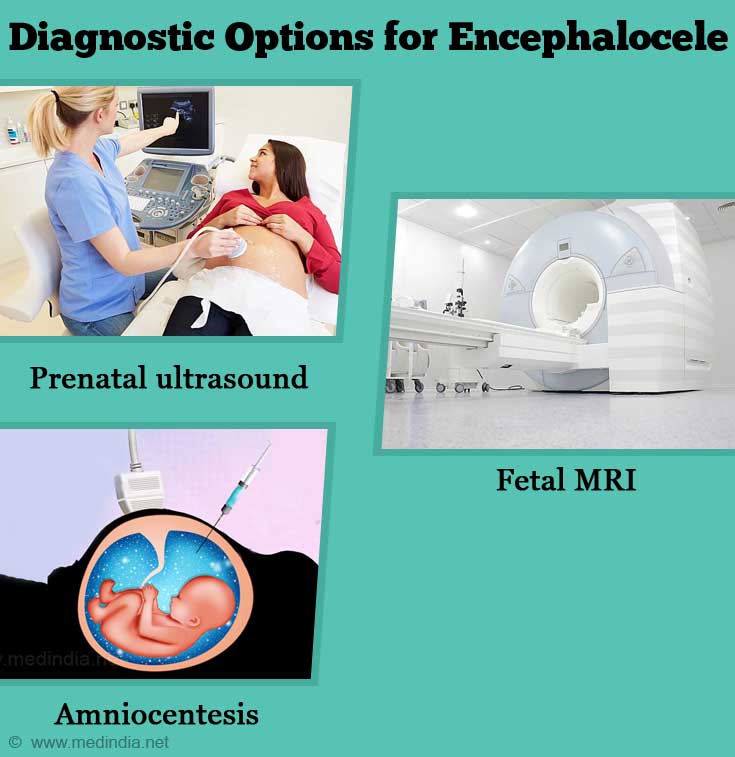 Diagnostic Options for Encephalocele Diagnostic Options for Encephalocele