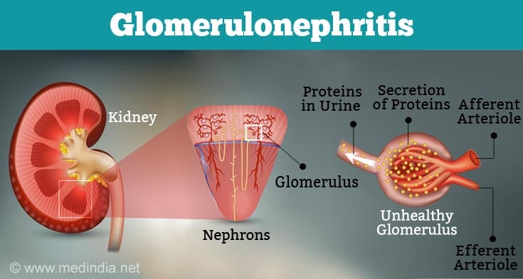 Dialysis - Hemodialysis, Peritoneal Dialysis and Role of Diet and Drugs