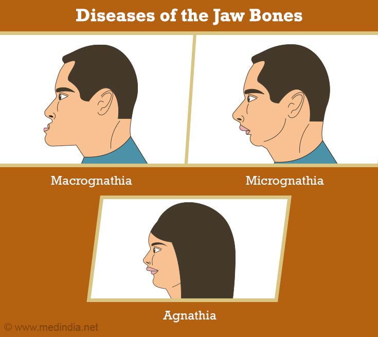 Diseases of the Jaw Bones Diseases of the Jaw Bones