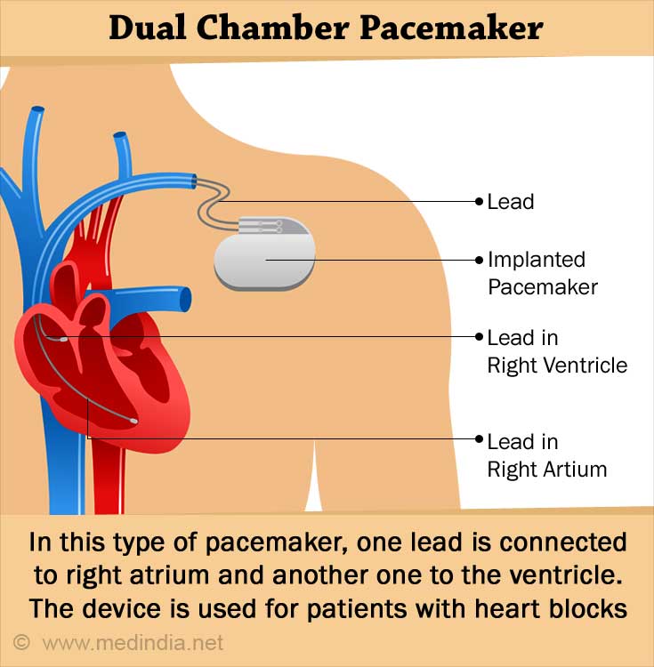 heart passmaker