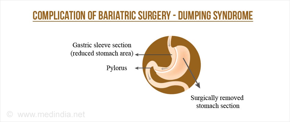 bariatric surgery complications