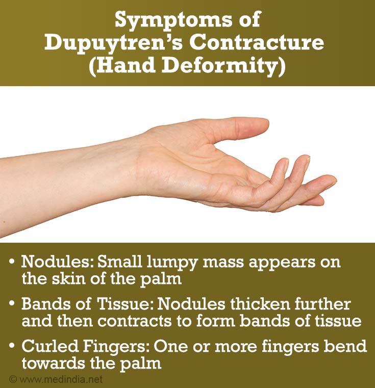 Dupuytren’s Contracture | Viking’s Disease - Causes, Risk Factors ...