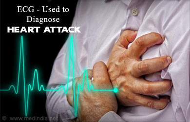 Electrocardiogram | ECG | EKG