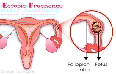 Ectopic Pregnancy Ectopic Pregnancy