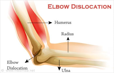 Elbow Dislocation - Causes, Symptoms, Diagnosis, Treatment