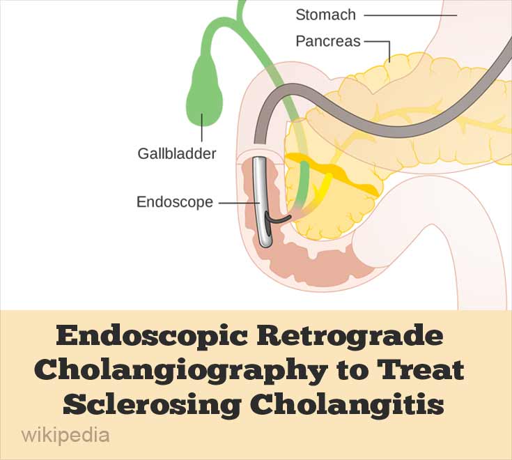 Endoscopic Retrograde Cholangiography to Treat Sclerosing Cholangitis Endoscopic Retrograde Cholangiography to Treat Sclerosing Cholangitis