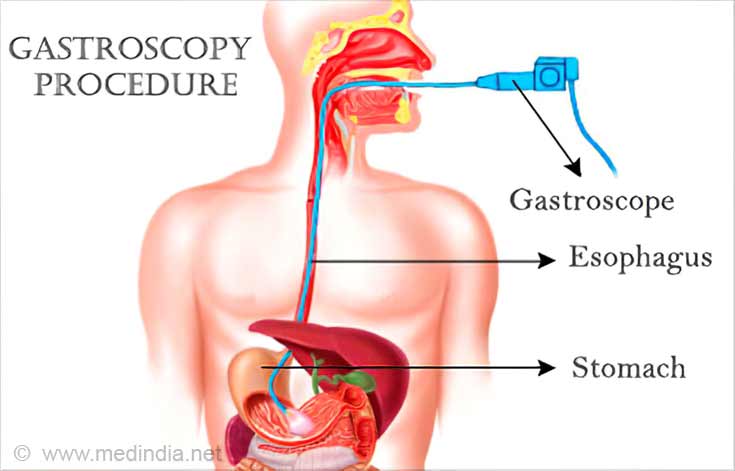 Gastroscopy Gastroscopy