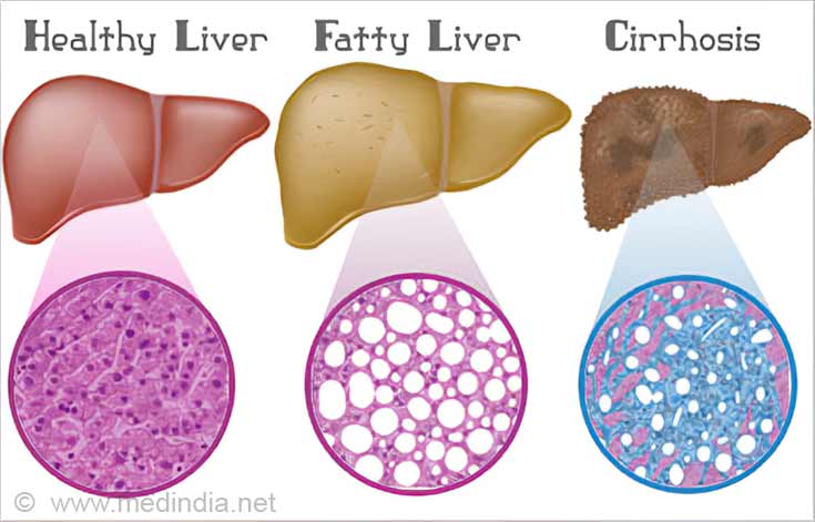 Fatty Liver Disease: A Growing Health Problem in India - Causes ...