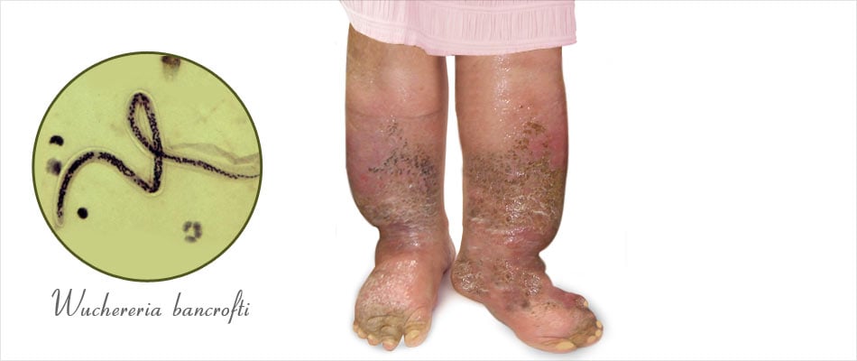 Filariasis Filariasis