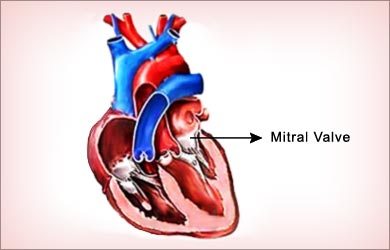Fragile X Syndrome Mitral Valve Fragile X Syndrome Mitral Valve