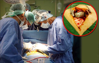 Gallbladder Surgery Open Cholecystectomy Gallbladder Surgery Open Cholecystectomy