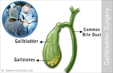 Gallbladder Surgery - Complications Side Effects FAQ