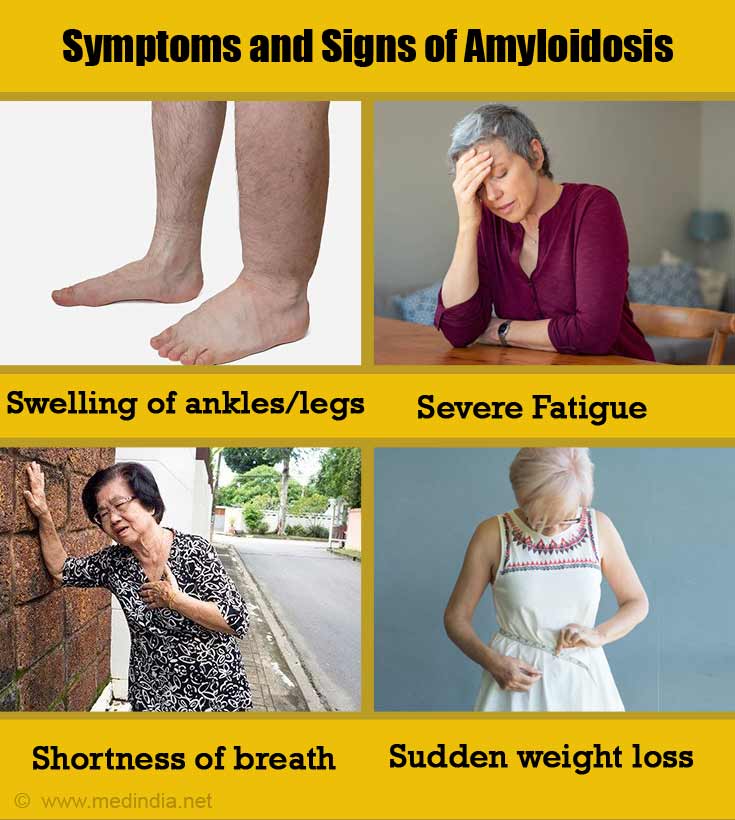 Causes Symptoms And Signs Of Amyloidosis 1835