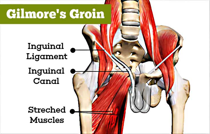 Gilmores Groin Causes Symptoms Signs Diagnosis Treatment