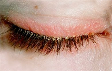 Granulated Eyelids Seborrheic Blepharitis Granulated Eyelids Seborrheic Blepharitis