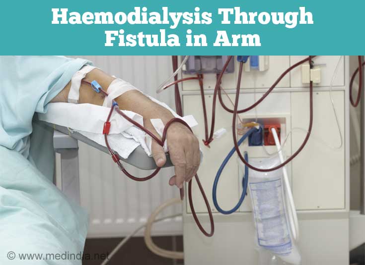 Dialysis - Hemodialysis, Peritoneal Dialysis and Role of Diet and Drugs