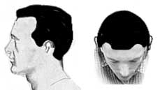 Hair Loss Stage II Hair Loss Stage II