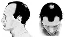 Hair Loss Stage III Hair Loss Stage III