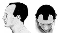 Hair Loss Stage III Hair Loss Stage III