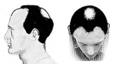 Hair Loss Stage IV Hair Loss Stage IV