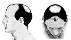 Hair Loss Stage V Hair Loss Stage V